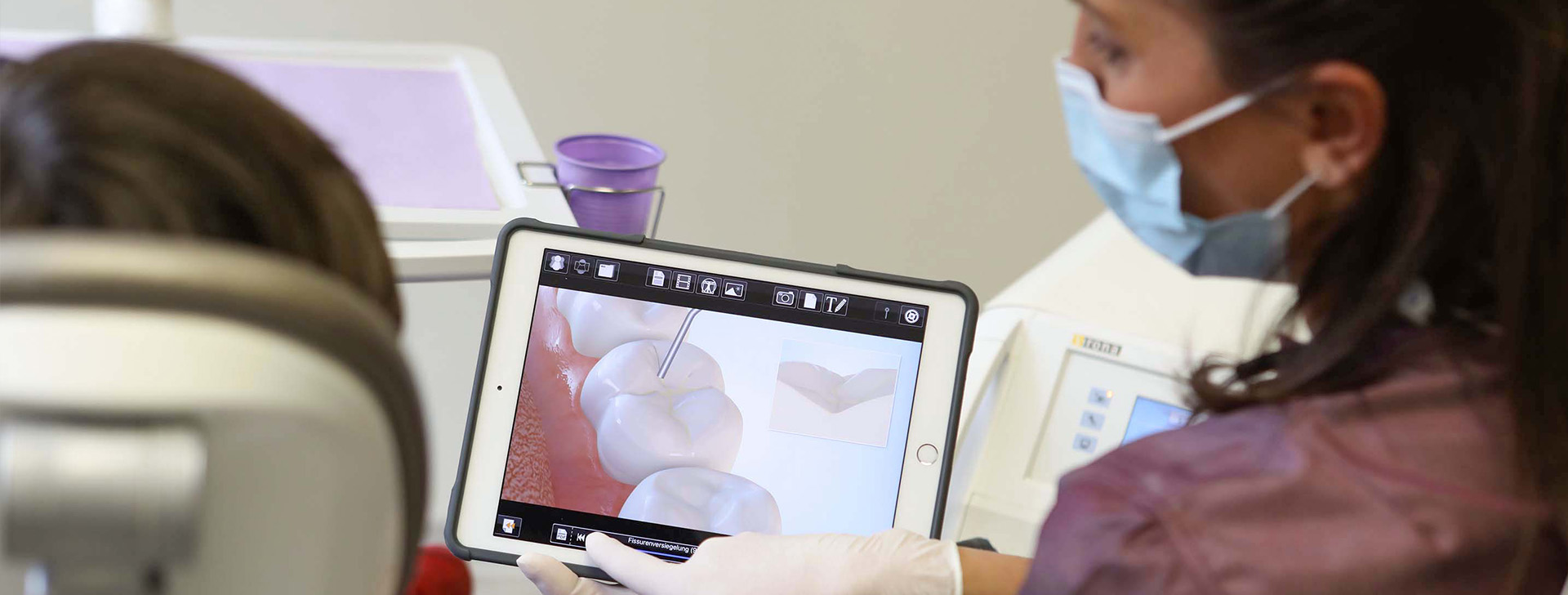 Zahnaerzte_am_Augustaplatz_Fissurenversiegelung