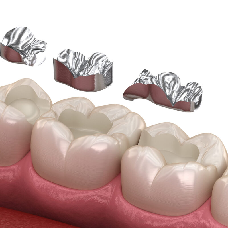 Zahnaerzte_am_Augustaplatz_Amalgamsanierung_Kachel Zahnaerzte_am_Augustaplatz_Amalgamsanierung_Kachel
